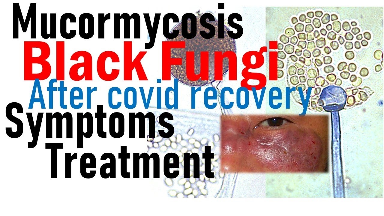 Mucormycosis _1 &nbs