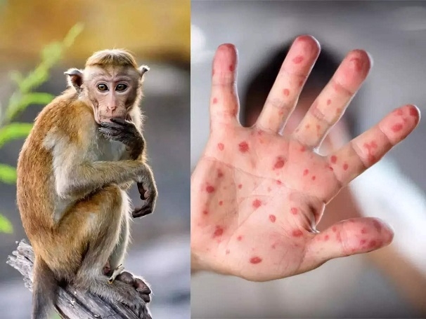 Monkey Pox